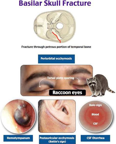 halo sign csf|Basal skull fracture and the halo sign